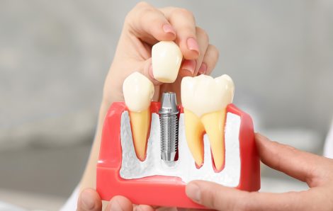 Do Dental Implants Stain Like Natural Teeth?