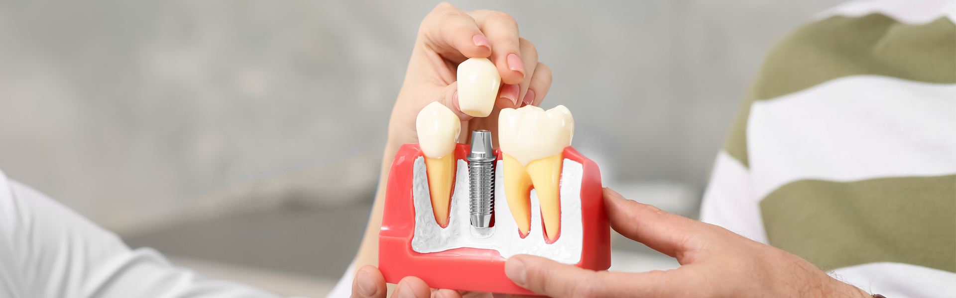 Do Dental Implants Stain Like Natural Teeth?