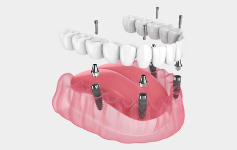 Decoding Dental Implants: Weighing the Ups and Downs of All 4 Options – Unveiling the Expert Insights from Tri-Cities Dental Specialists