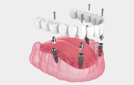 Tips for a Comfortable Recovery After All-on-4 Dental Implants