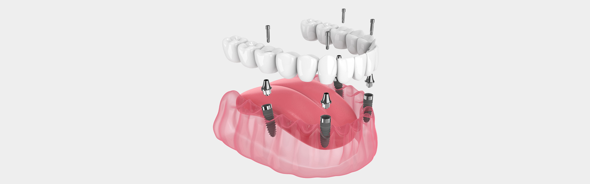 Tips for a Comfortable Recovery After All-on-4 Dental Implants